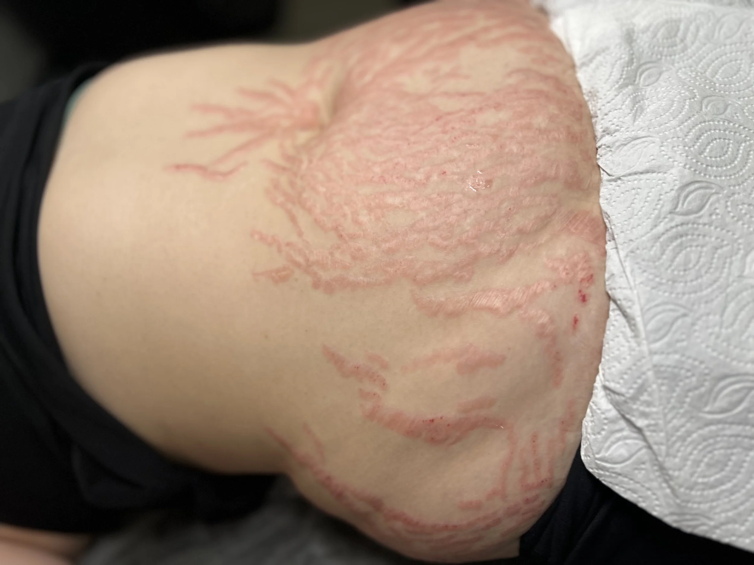 A person's back showing a red, inflamed skin condition, possibly a rash or skin irritation, with visible branching patterns resembling veins or an allergic reaction.