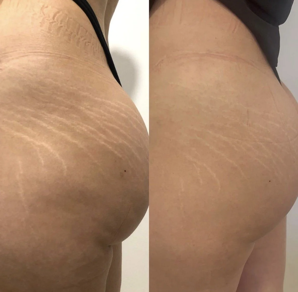 A side-by-side comparison of a person's buttocks, showing the before and after appearance of the skin, with the skin appearing smoother and more even in the after image.