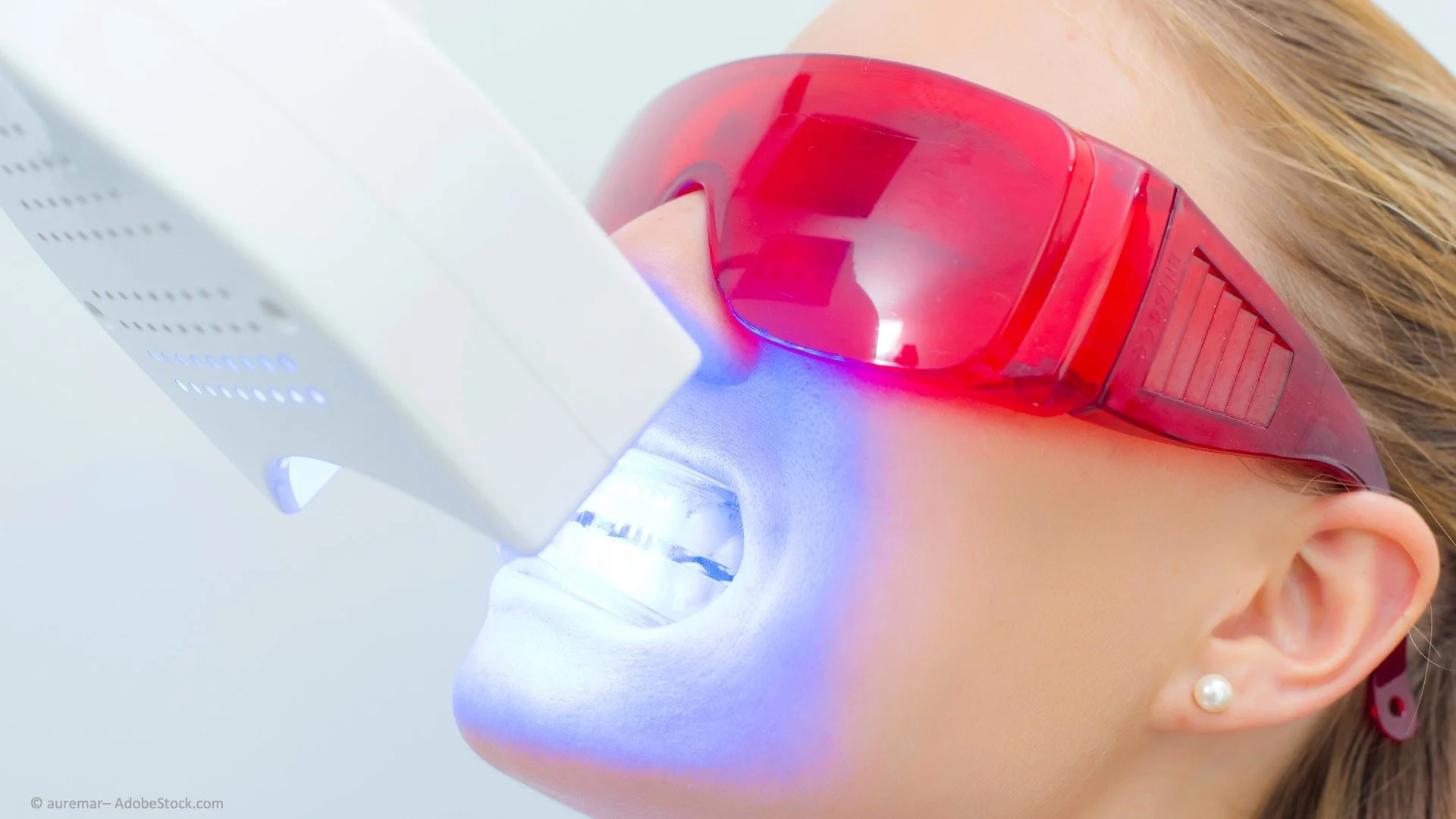 Mensch erhält eine professionelle Zahnaufhellung mit blauer UV-Licht-Therapie, trägt rote Schutzbrille, moderner Dentalapparat im Einsatz.