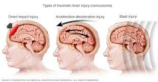 Post-Concussion Care: Why the Neck and Balance Matter (and How We Test Them)