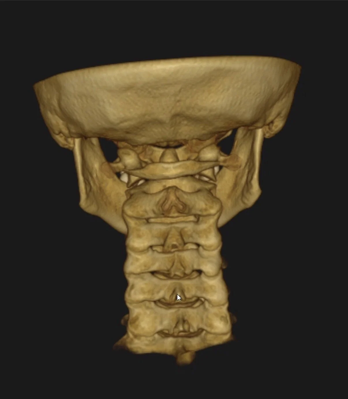 A 3D rendering of a human cervical spine and skull base shown from below, with detailed bony structures.