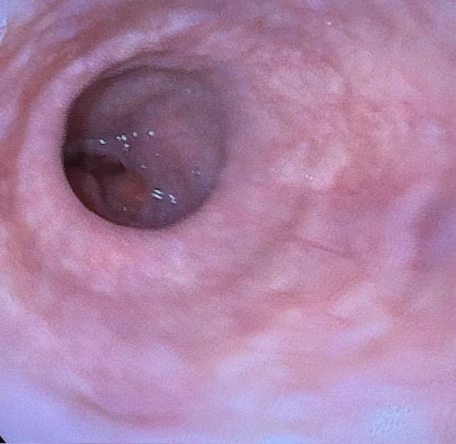 Eosinofil øsofagitt