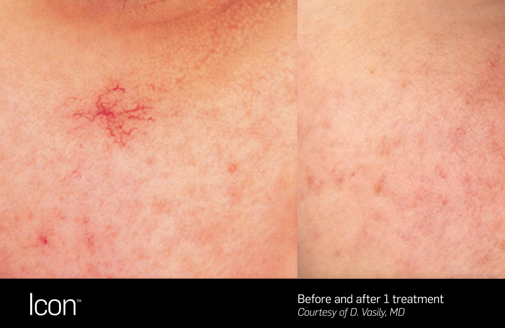 Telangiectasia | Cheek