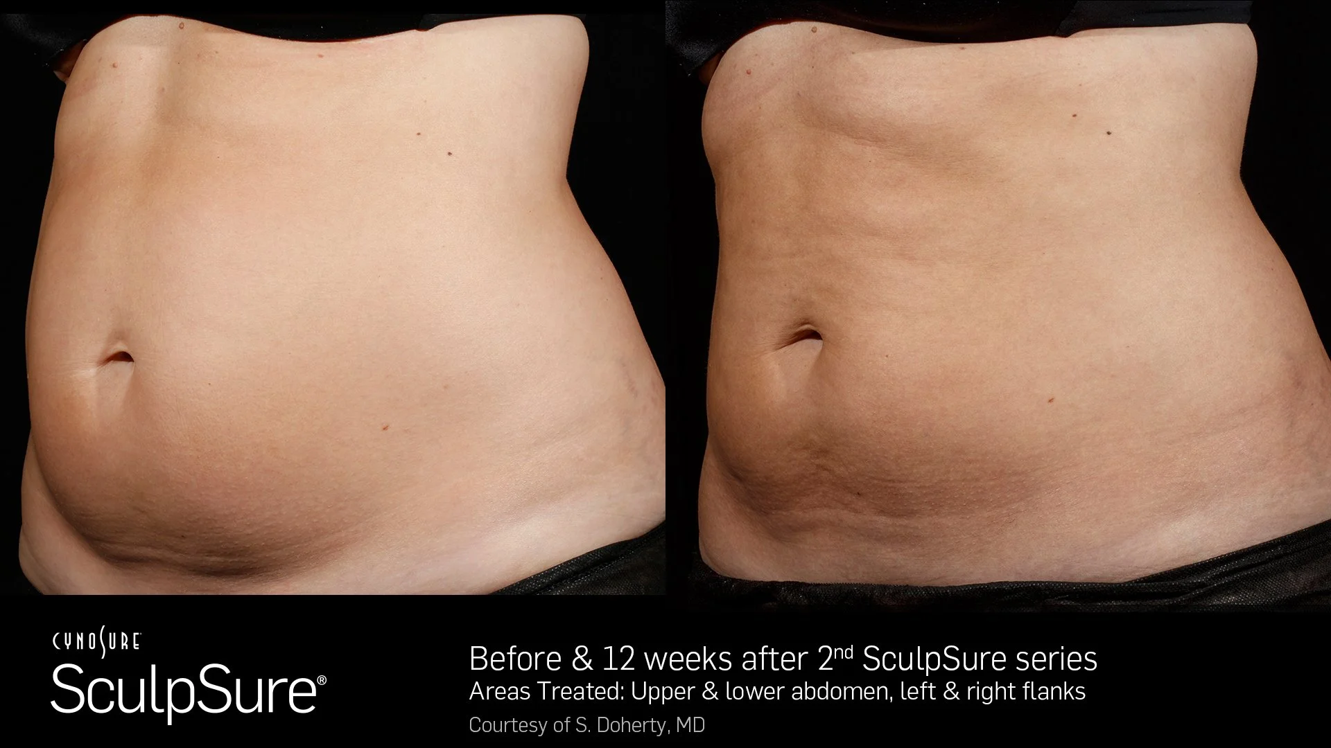 SculpSure Fotos A&D 2 tratamentos 12 semanas b.jpg