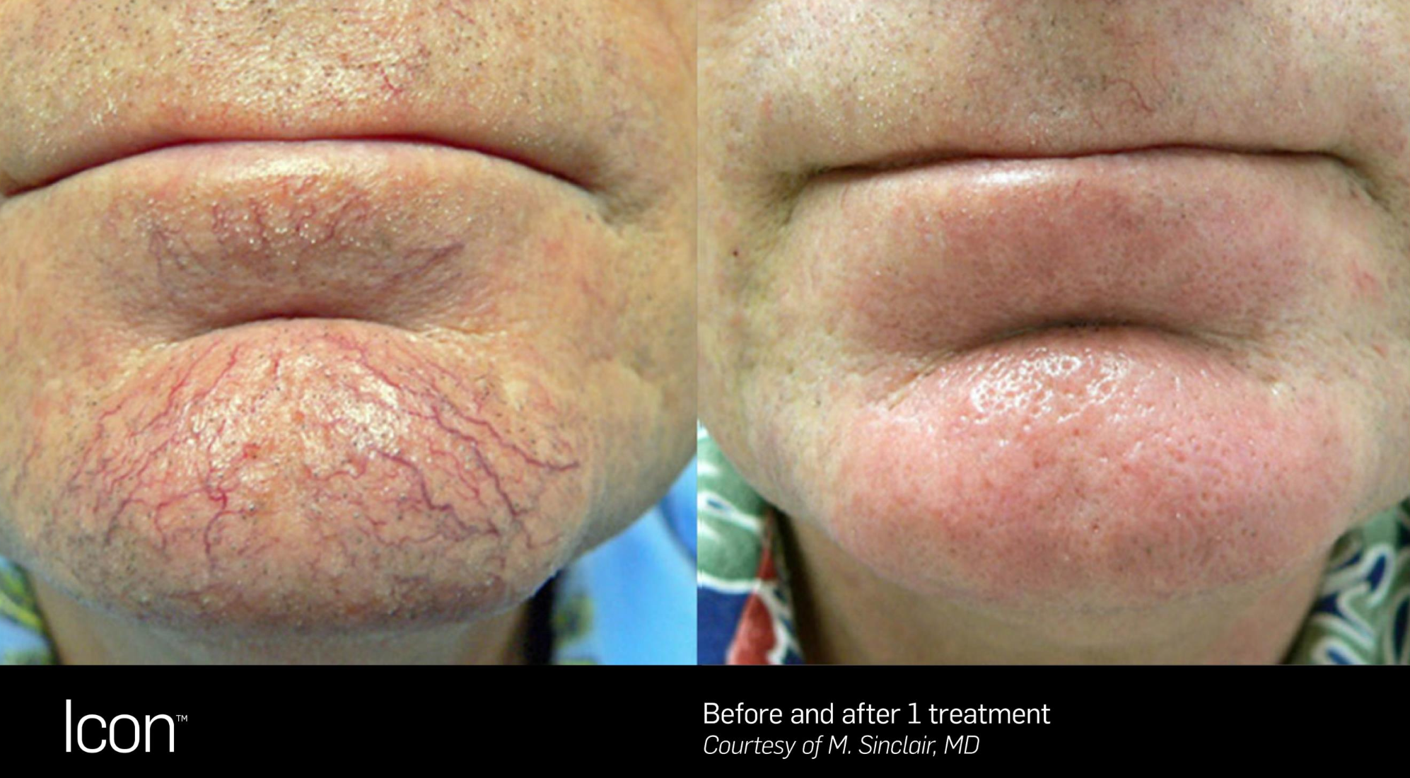 Facial Veins | Slideshow 2.png