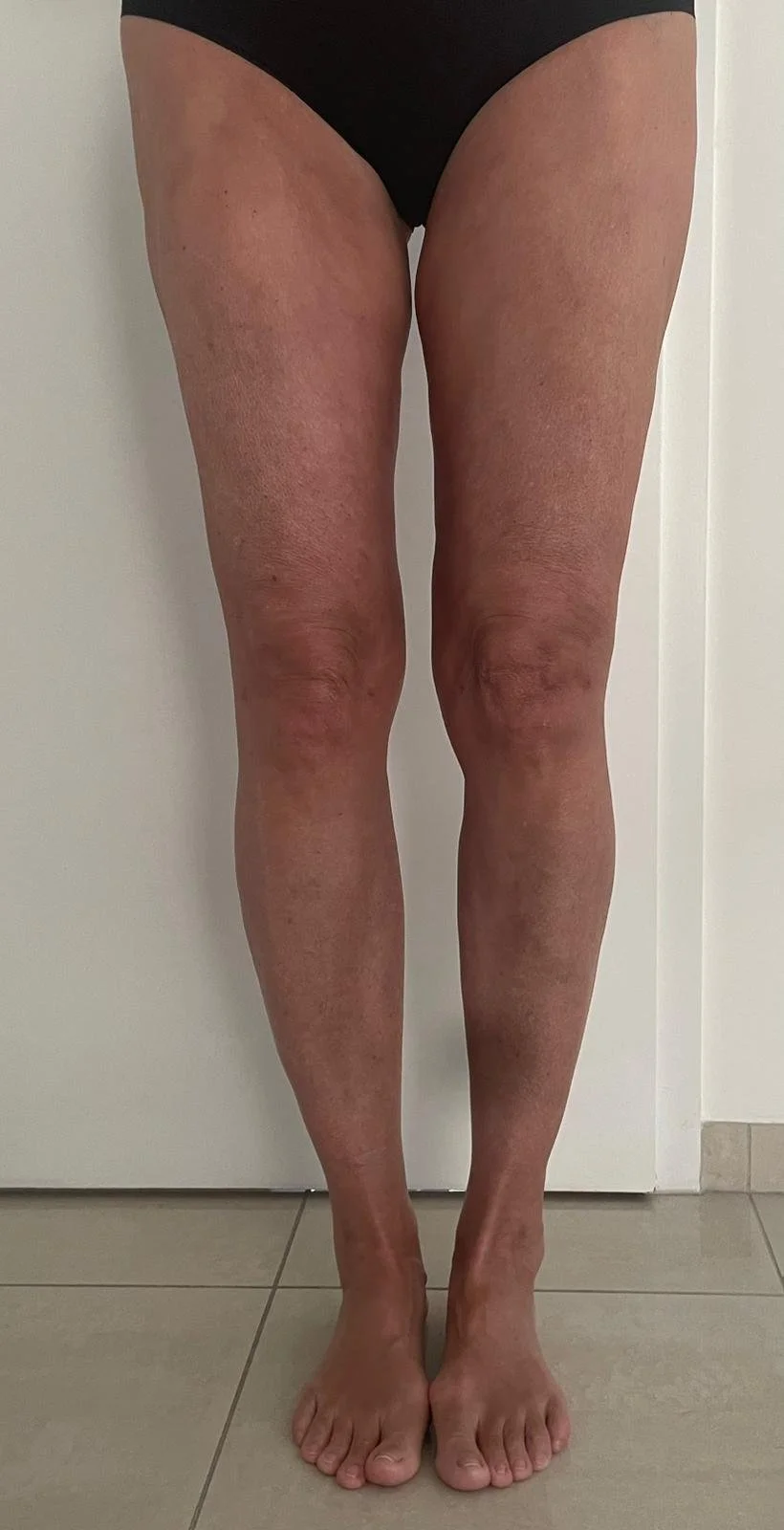 Liposuktion Vorher-Nachher Zollstock – Blaue Flecken weg in 3 Wochen!