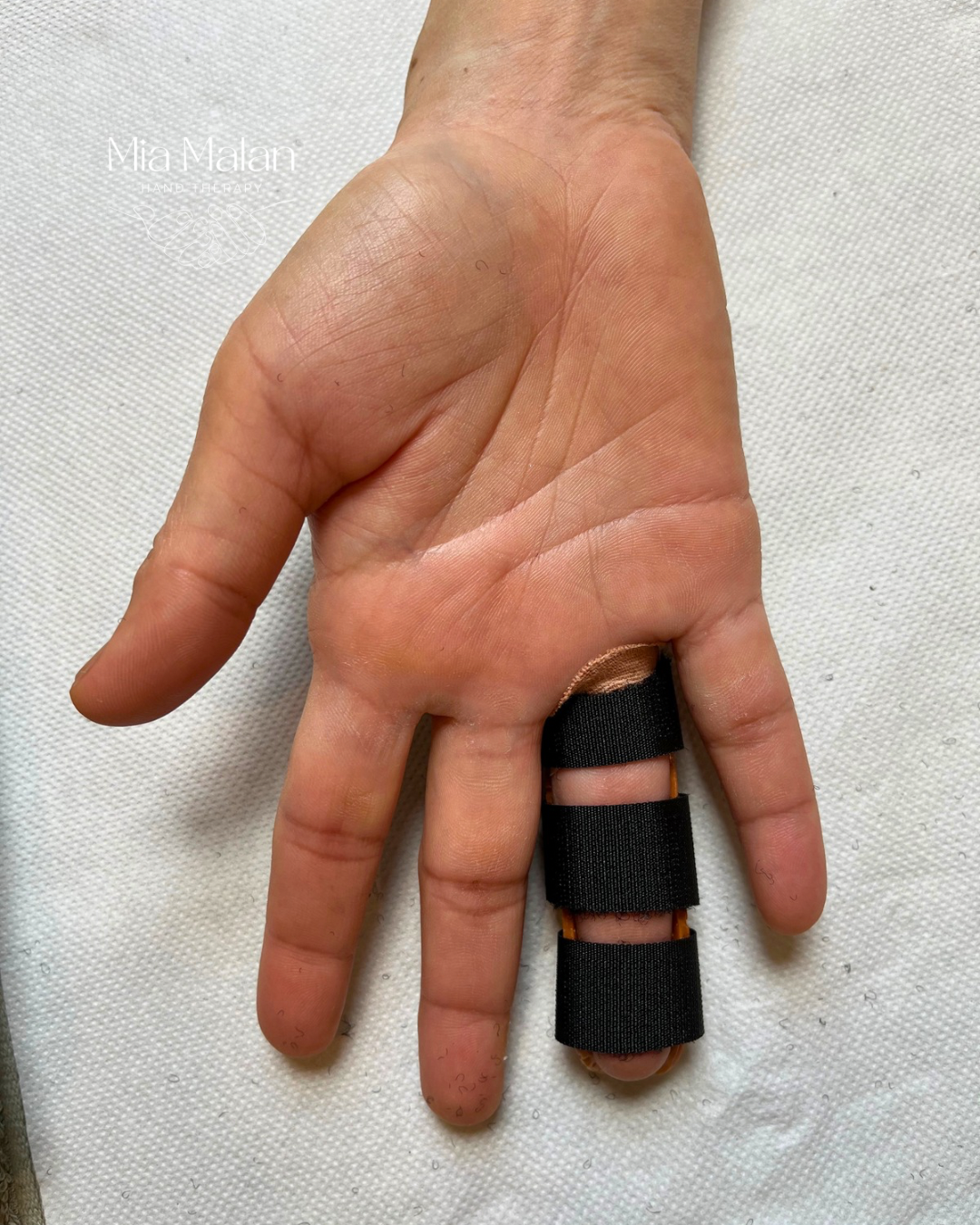 Finger Dislocation: Why It's Still Swollen Weeks Later