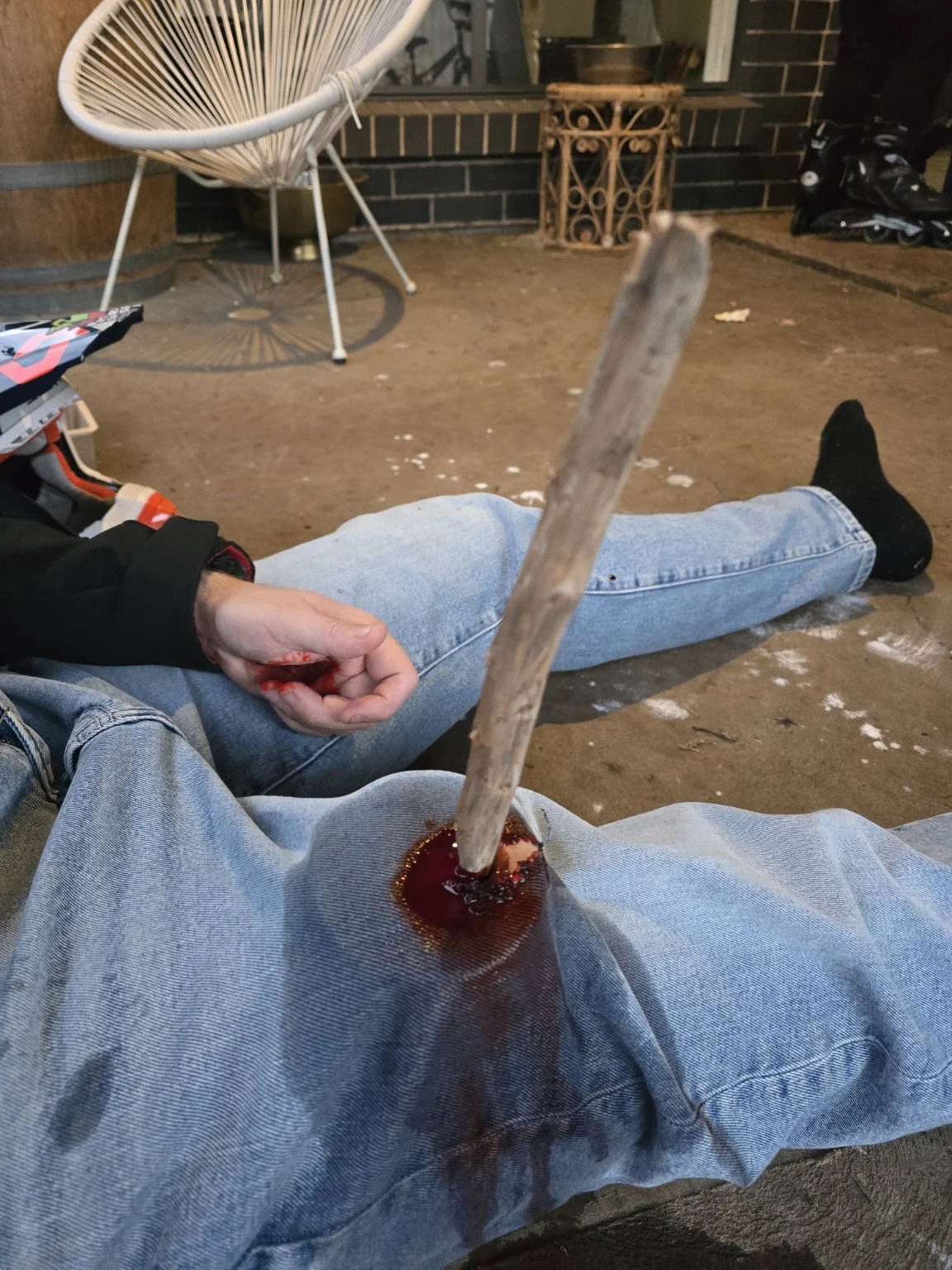 Wound treatment 