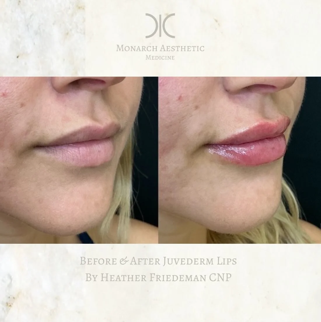 #hellobeautiful ! #juvedermlips do not disappoint! #beforeandafter #lipfiller on this #beauty #booknow get #holidayready ! 
☎️6145452002
💻www.monarch-aesthetic.com
#lipfillerbeforeandafter #transformationtuesday #medspa #medspalife #columbusmedspa #