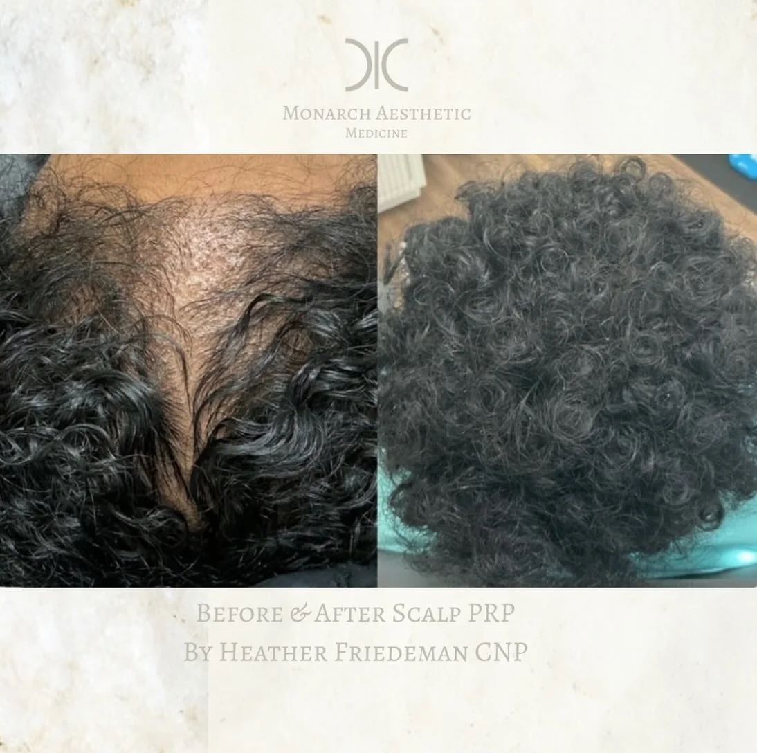 #scalpprp is #amazing ! #checkout this incredible #beforeandafter of a series or #prpscalp #injections with #sunetics #hairgrowth #laser ! #booknow ! Who doesn&rsquo;t want #thickerhair ?! 
☎️6145452002
💻www.monarch-aesthetic.com
#transformationtues