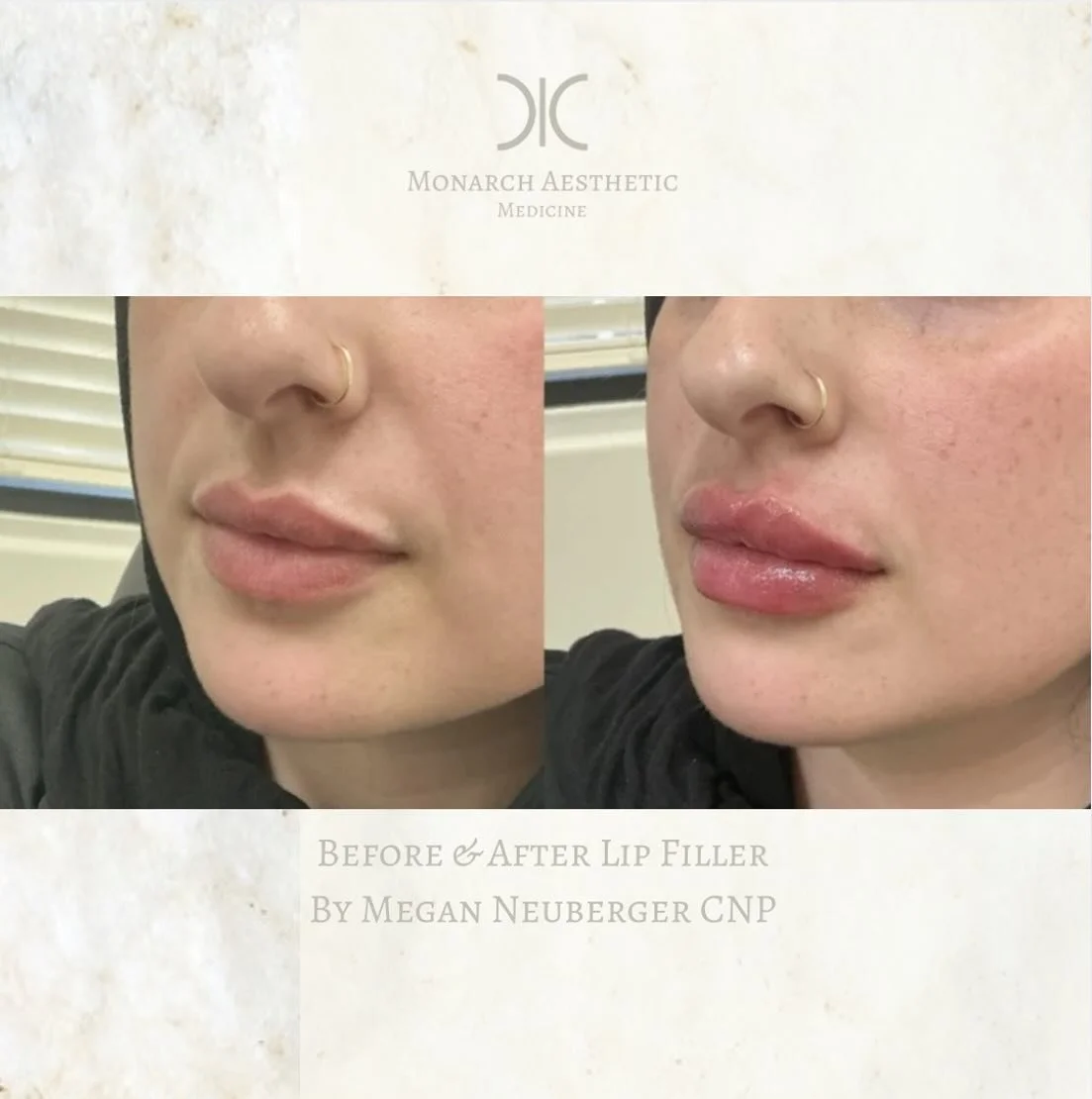 #lipfiller #perfection ! #beforeandafter #lips for this #beauty #booknow 
☎️6145452002
💻www.monarch-aesthetic.com
#filler #juvedermlips #restylanelips #lipenhancement #lipenvy #medspa #medspalife #columbusmedspa #aesthetic #aesthetics #ａｅｓｔｈｅｔｉｃ #be