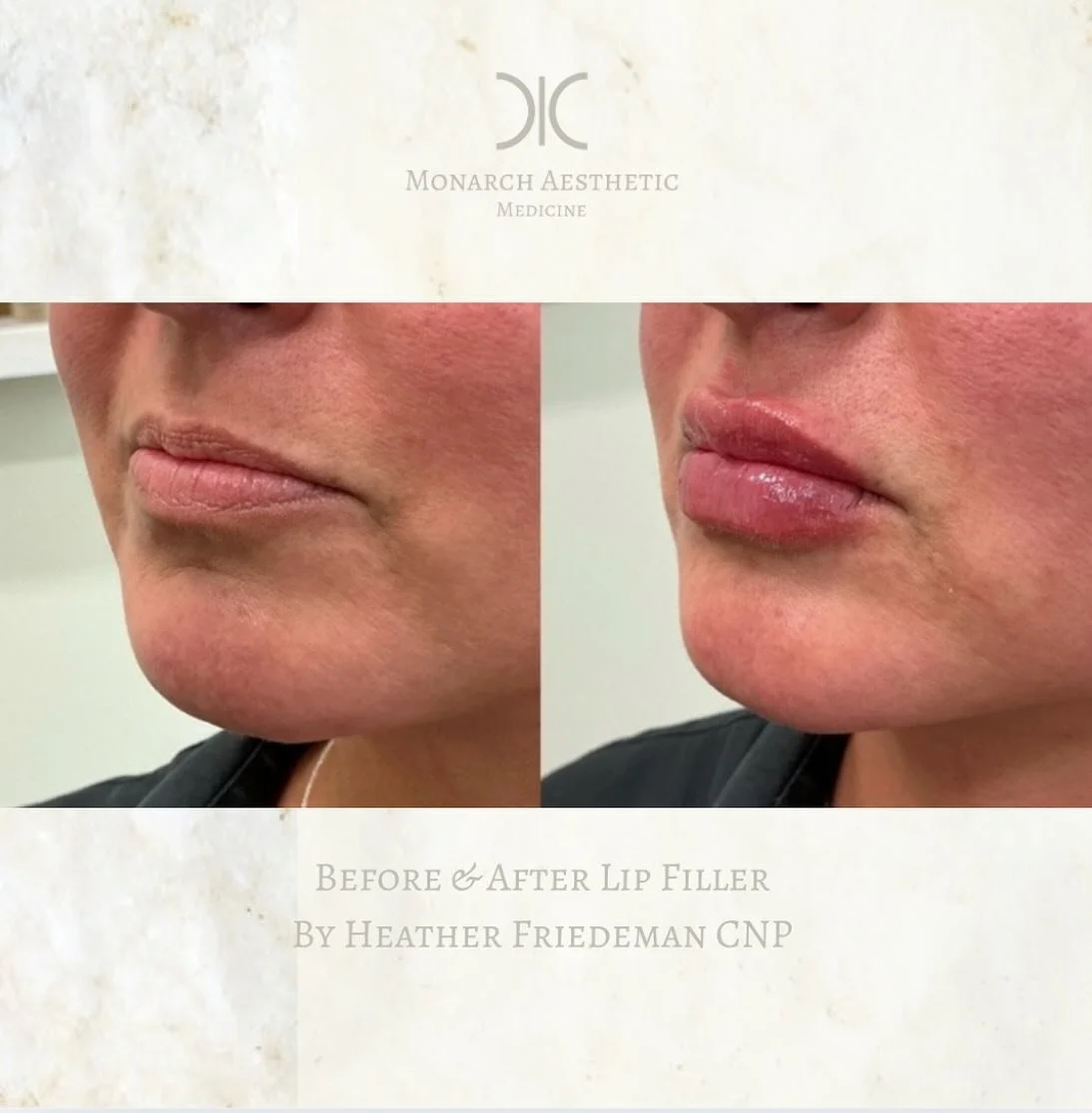 #restylanelips doing their thing! Improving proportion and hydration with #restylanel ! #booknow 
☎️6145452002
💻www.monarch-aesthetic.com
#lipfiller #lipfillerbeforeandafter #beforeandafter #transformationtuesday #medspalife #medspamagic #columbusme