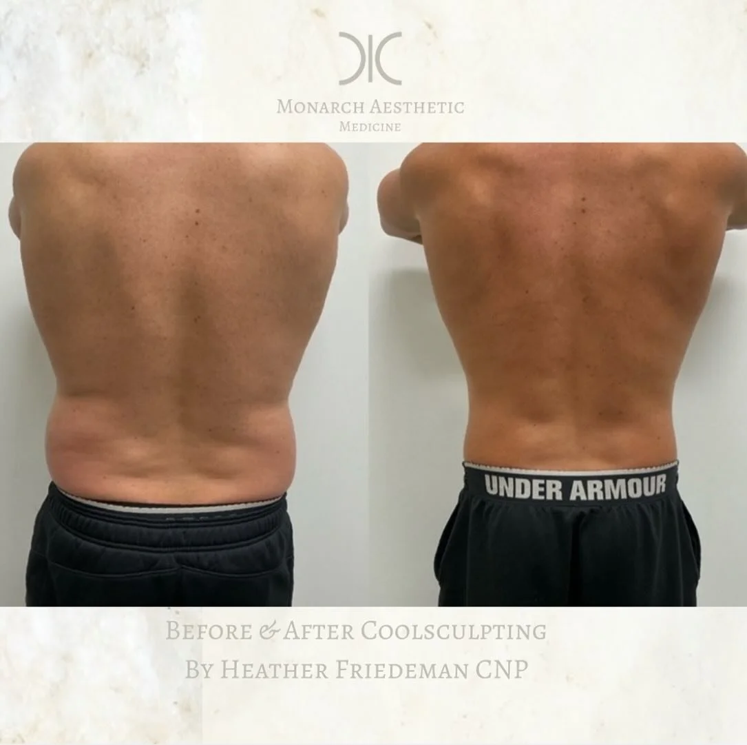 This is why we #treattocomplete with #coolsculpting ! 2 full rounds of #abdomen #flanks and #chest is a #gamechanger ! #ladies get your #men the #gift they want for the #holidays ! #booknow 
☎️6145452002
💻www.monarch-aesthetic.com
#results #coolscul