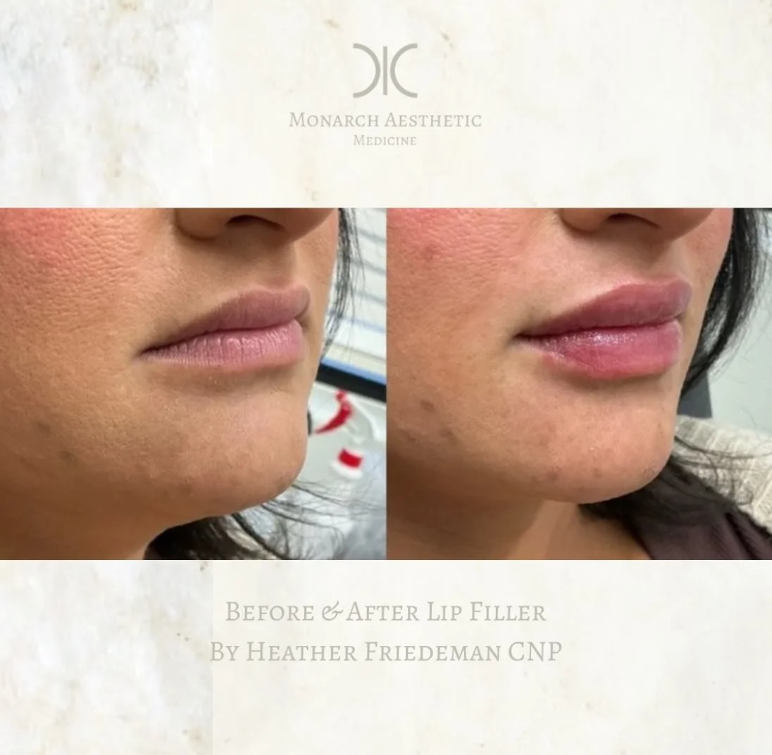 These #lippies are #holidayready ! #booknow for your #holidayglowup 
☎️6145452002
💻www.monarch-aesthetic.com
#lipfiller #lipfillerbeforeandafter #beforeandafter #transformationtuesday #medspalife #columbusmedspa #aesthetic #ａｅｓｔｈｅｔｉｃ #aesthetics #be