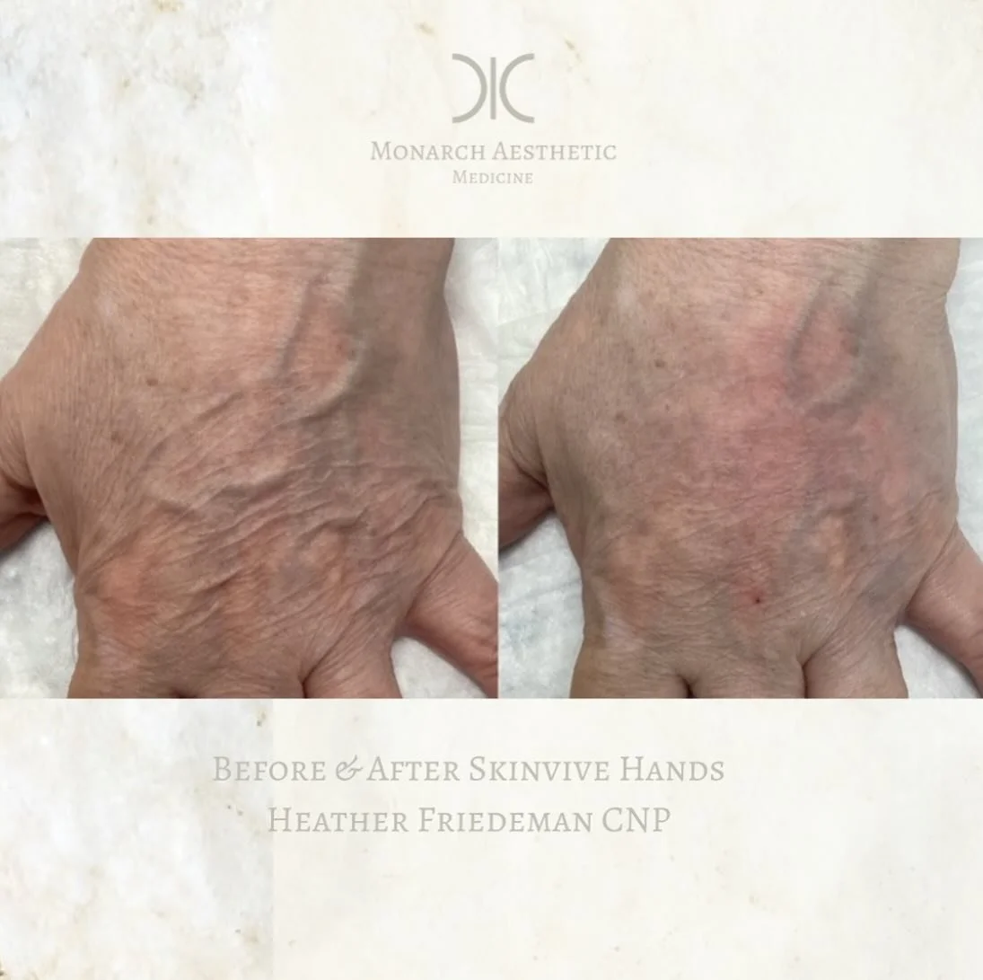 #dry #winterskin #aging your #hands ?! #skinvive is here to help! #hydrate and smooth #skin ! #ʙᴏᴏᴋɴᴏᴡ 
☎️6145452002
💻www.monarch-aesthetic.com
#beforeandafter #transformationtuesday #handfiller #medspalife #medspa #columbusmedspa #antiaging #skinca