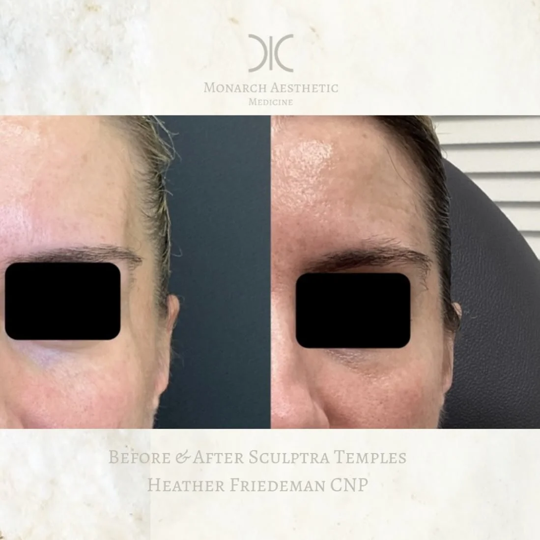 The power of #sculptra ! #naturally building and restoring #collagen in the #skin . #amazing #beforeandafter #sculptraseries for the #temples . #rejuvenate the upper face with #longlasting #results ! #sculptraaesthetic and all other #injectables will