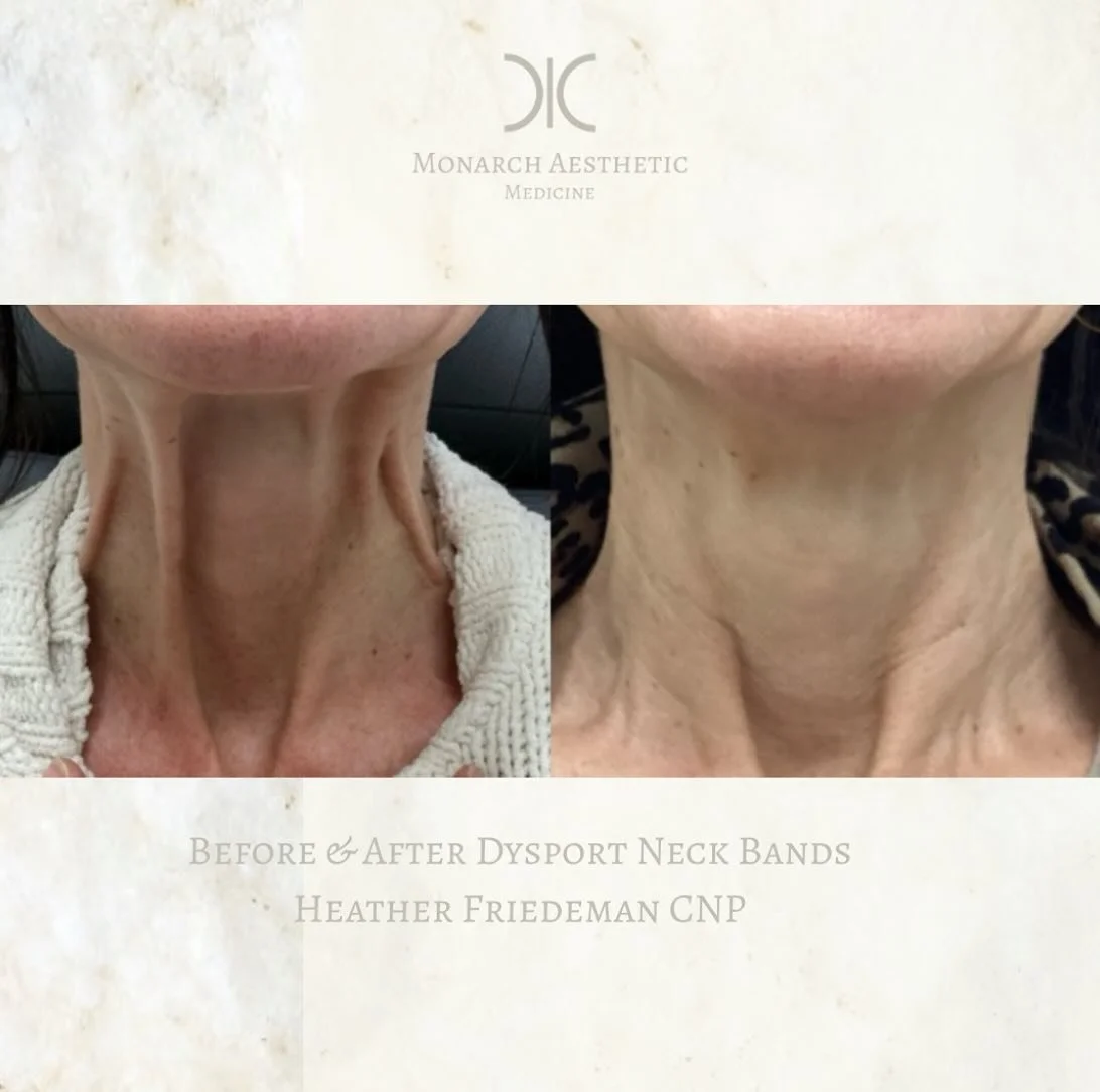 The power of #platysmalbandbotox ! #aginginreverse ! #beforeandafter #dysport&reg; for #neckbands ! 
☎️6145452002
💻www.monarch-aesthetic.com
#tox #expertinjector #medspalife #medspa #columbusmedspa #aesthetic #aesthetics #transformationtuesday #beau