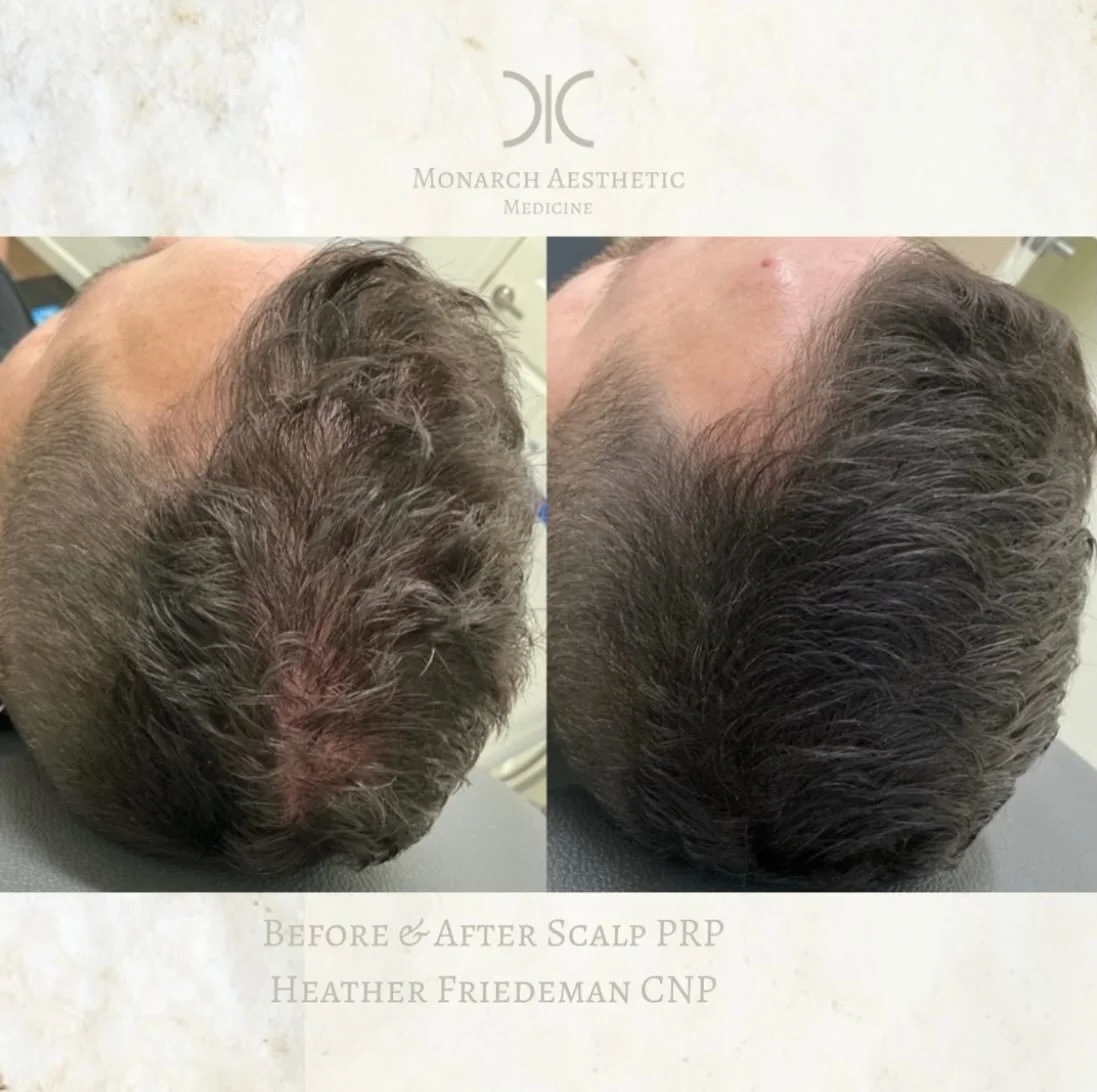 Combo treatments really are the best for #hairloss ! This is Heathers husband after his third #scalpprp treatment. He also takes #nutrafol daily and uses the #obagi #hairgrowthserum ! loving these results! Whether you have hair loss that is genetic, 