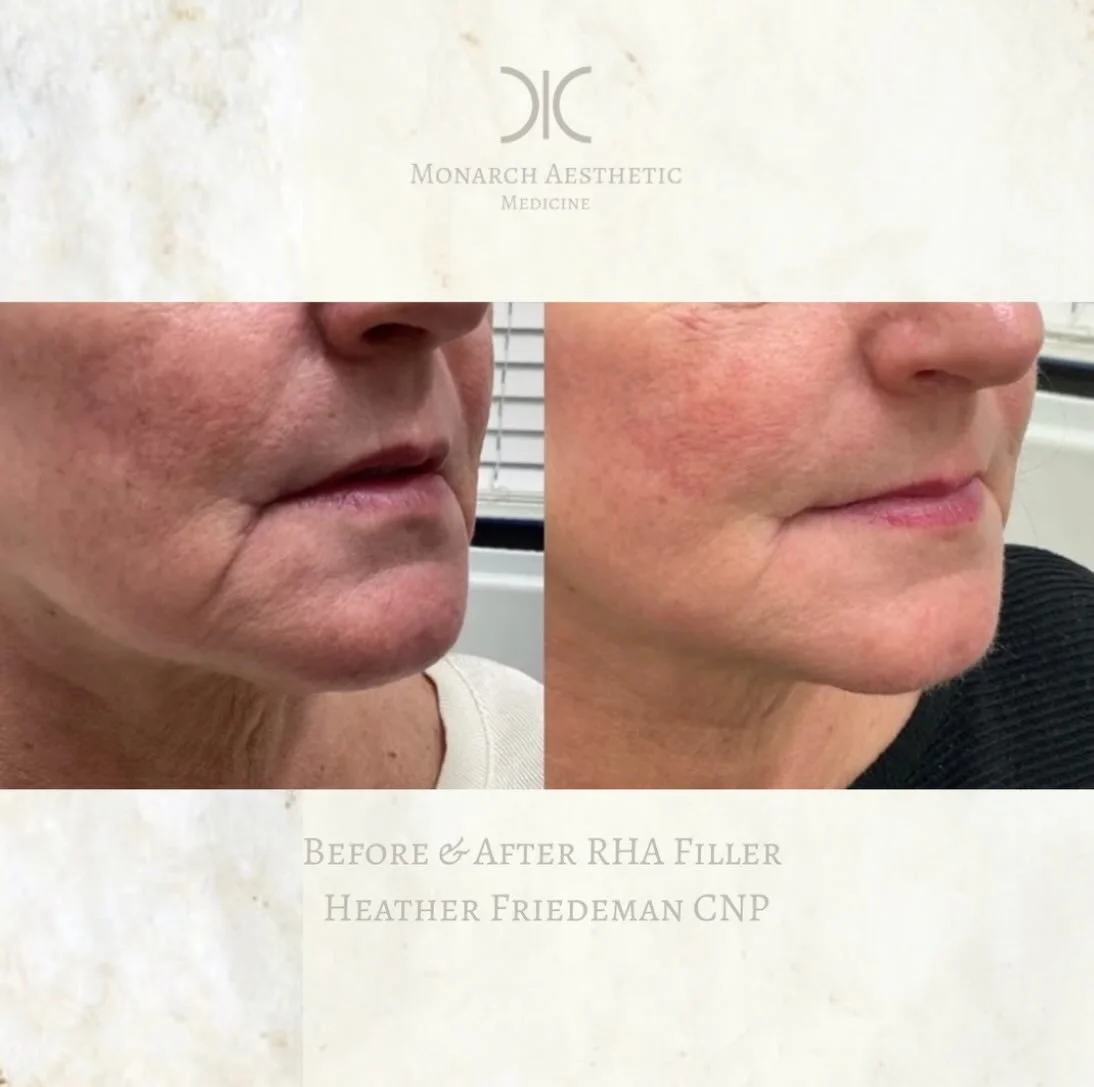 Not bringing our marionette lines into 2026 here! Another beautiful #fillerbeforeandafter ! #aginginreverse ! #booknow 
☎️6145452002
💻www.monarch-aesthetic.com
#medspa #columbusmedspa
