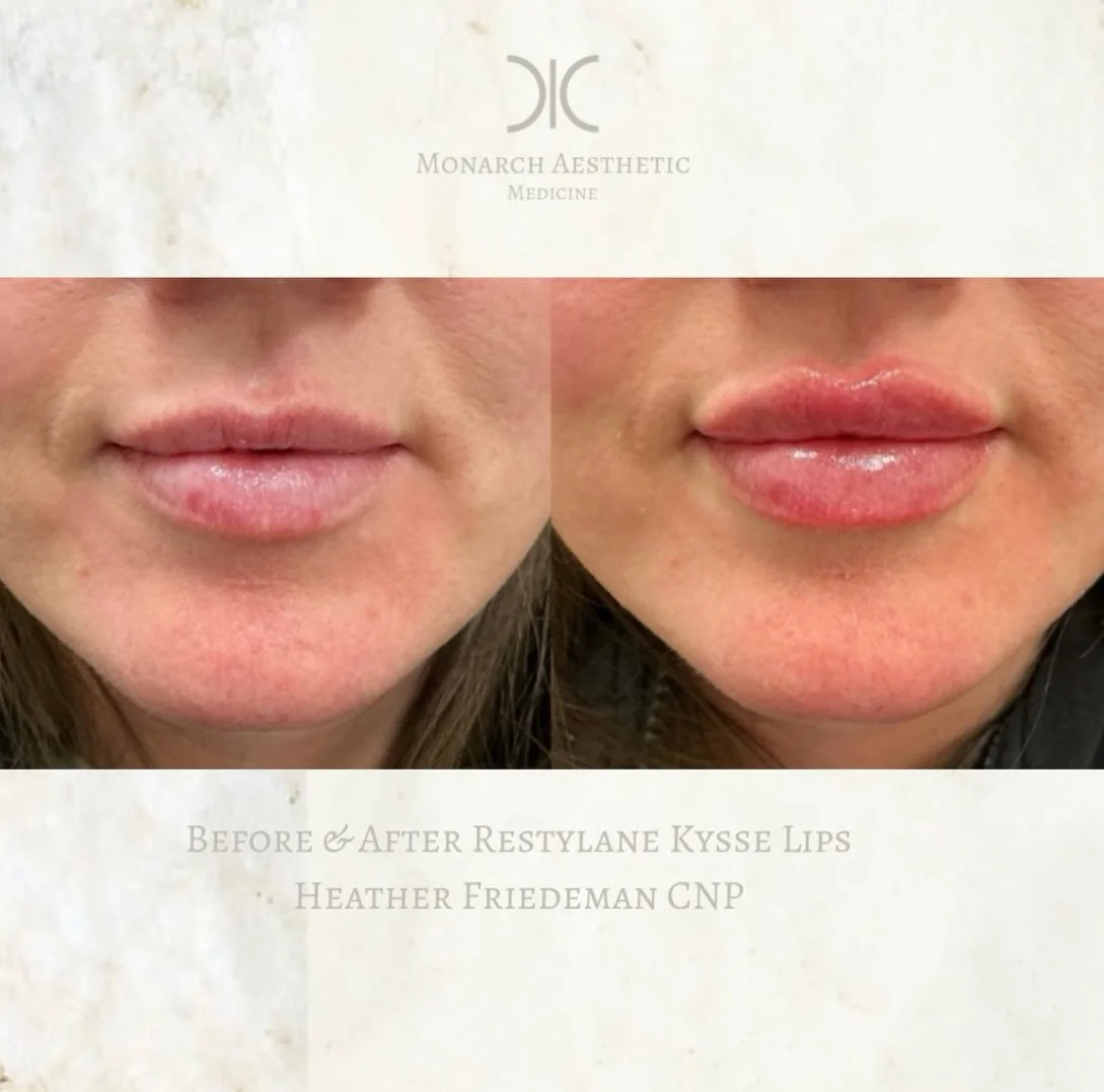 Coming out of the snowpocolypse with #🔥 #lips ! #obsessed with these #restylanekysse results! #beforeandafter 
☎️6145452002
💻www.monarch-aesthetic.com