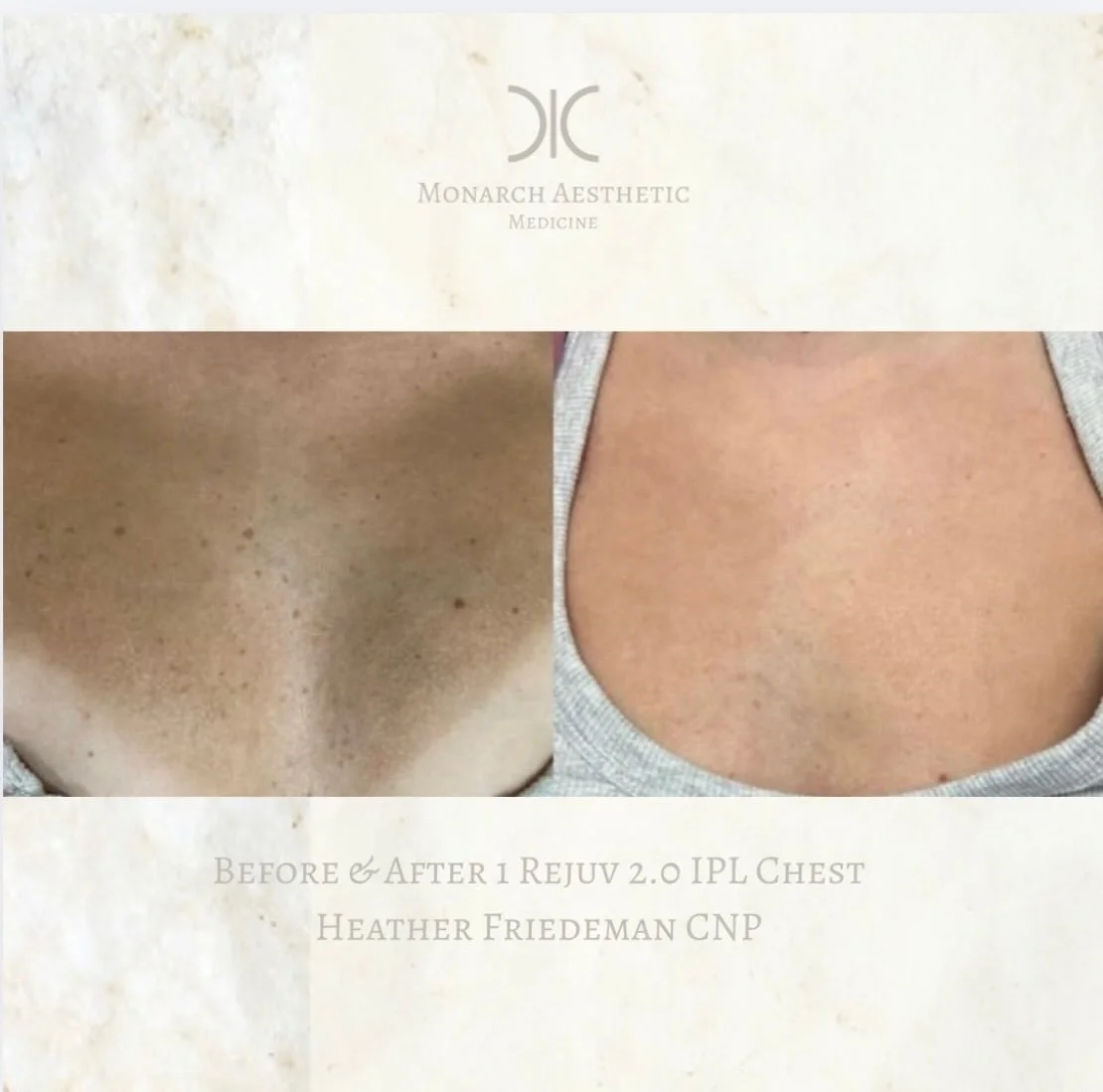 Don&rsquo;t forget the neck and chest! #laserseason is in full effect getting rid of all our summer #sundamage ! This #beforeandafter is post just 1 #ipl rejuv treatment! #booknow ! 
☎️6145452002
💻www.monarch-aesthetic.com
