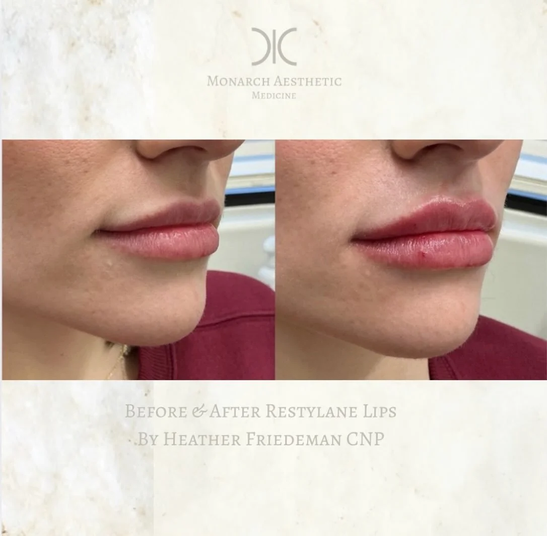 Everyone is loving the #minilip plump this month! Last few days for the $349 #lipfiller 1/2 syringe #restylanefiller #beforeandafter #medspa