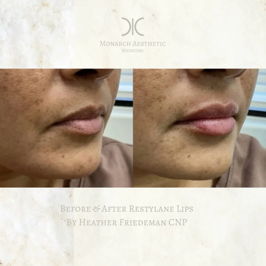 So many #lipminis ! #perfection #beforeandafter #columbusmedspa #lipfiller 
☎️6145452002
💻www.monarch-aesthetic.com