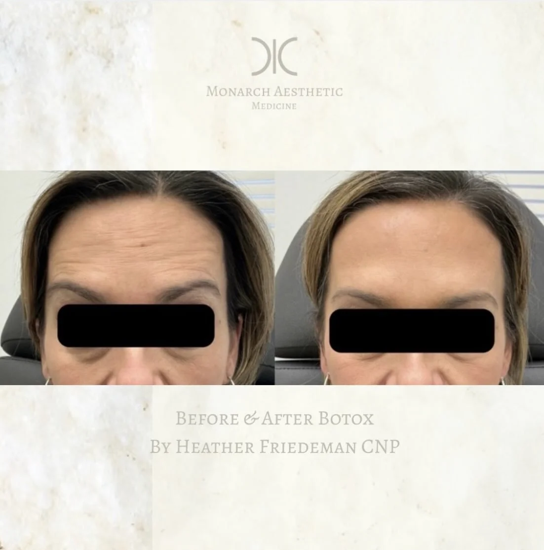 Are you #springbreakready ?! Now&rsquo;s the time for #tox ! #booknow #columbusmedspa #beforeandafter 
☎️6145452002
💻www.monarch-aesthetic.com
