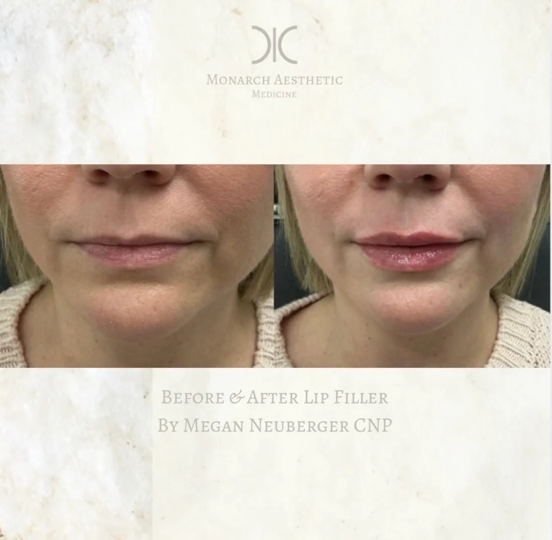 We love a natural #lipplump ! #beforeandafter #lipfillers #columbusmedspa #aesthetics 
☎️6145452002
💻www.monarch-aesthetic.com