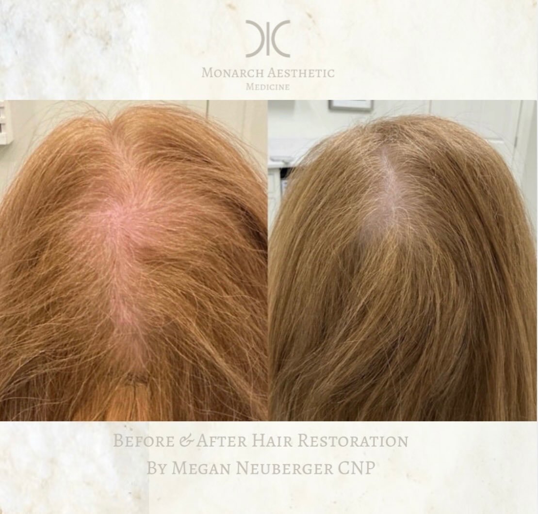 #thickerhair is always in season! Amazing #beforeandafter for #hairrestoration ! #transformationtuesday #columbusmedspa 
☎️6145452002
💻www.monarch-aesthetic.com