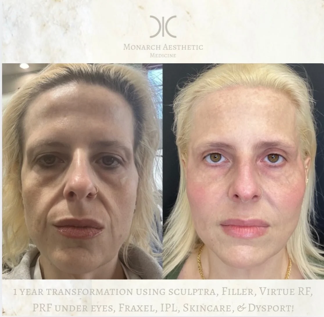The most incredible #transformation ! #weightloss is amazing but the changes to facial volume with rapid weight changes can have a huge impact on our facial contour, aging, and self esteem. This is the power of #nonsurgical #results from volume repla