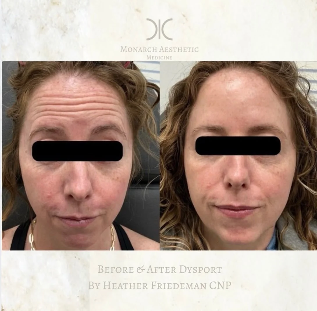 Love a first time #dysport&reg; #transformation ! #beforeandafter #freshtox #columbusmedspa 
☎️6145452002
💻www.monarch-aesthetic.com