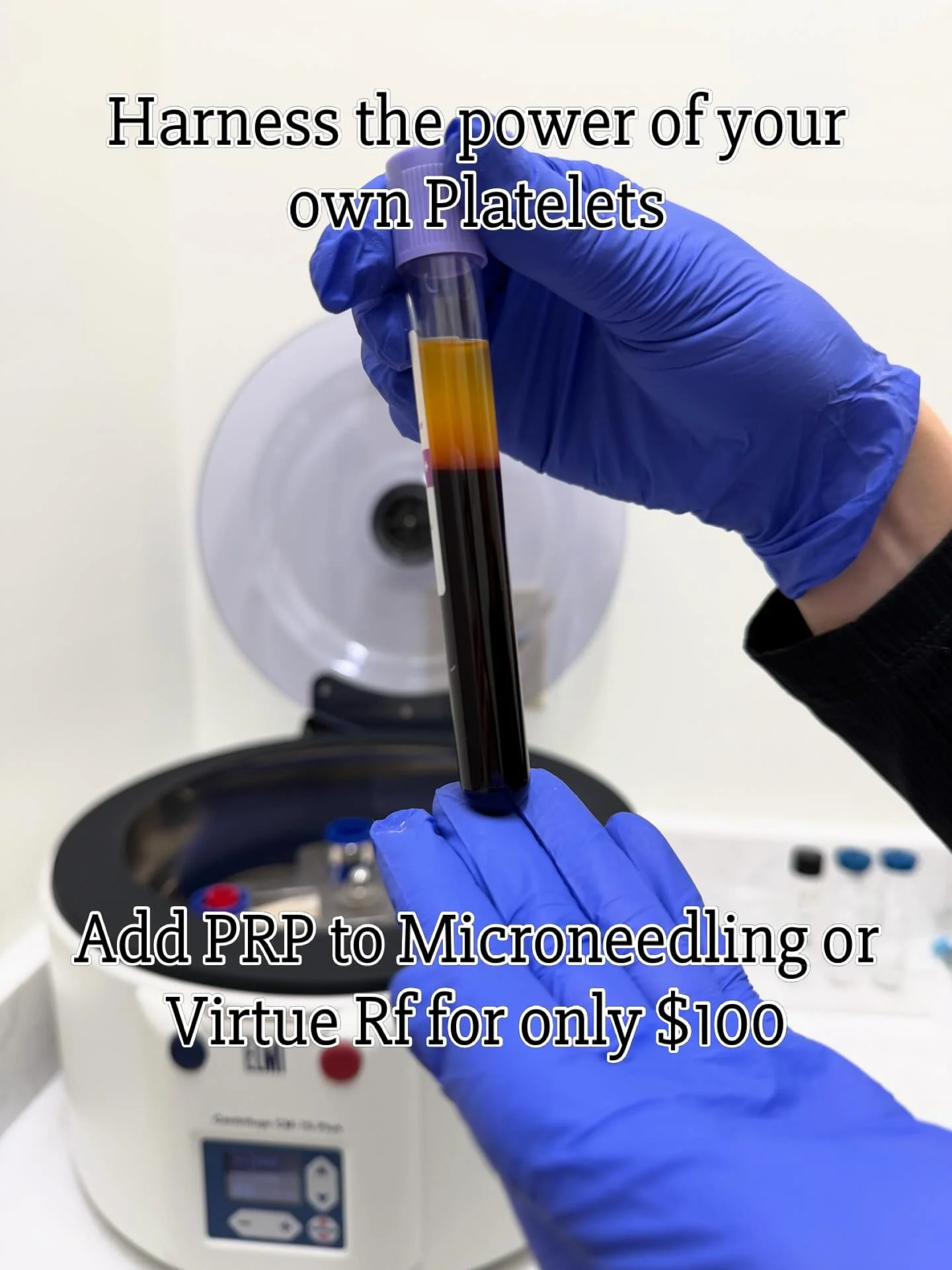Increase the efficacy of your treatment and accelerate your recovery- add prp to any Microneedling or Virtue RF treatment for only $100!

☎️ 614-545-2002
💻 info@monarch-aesthetic.com

#microneedling #skinpen #prpmicroneedling #virtuerf