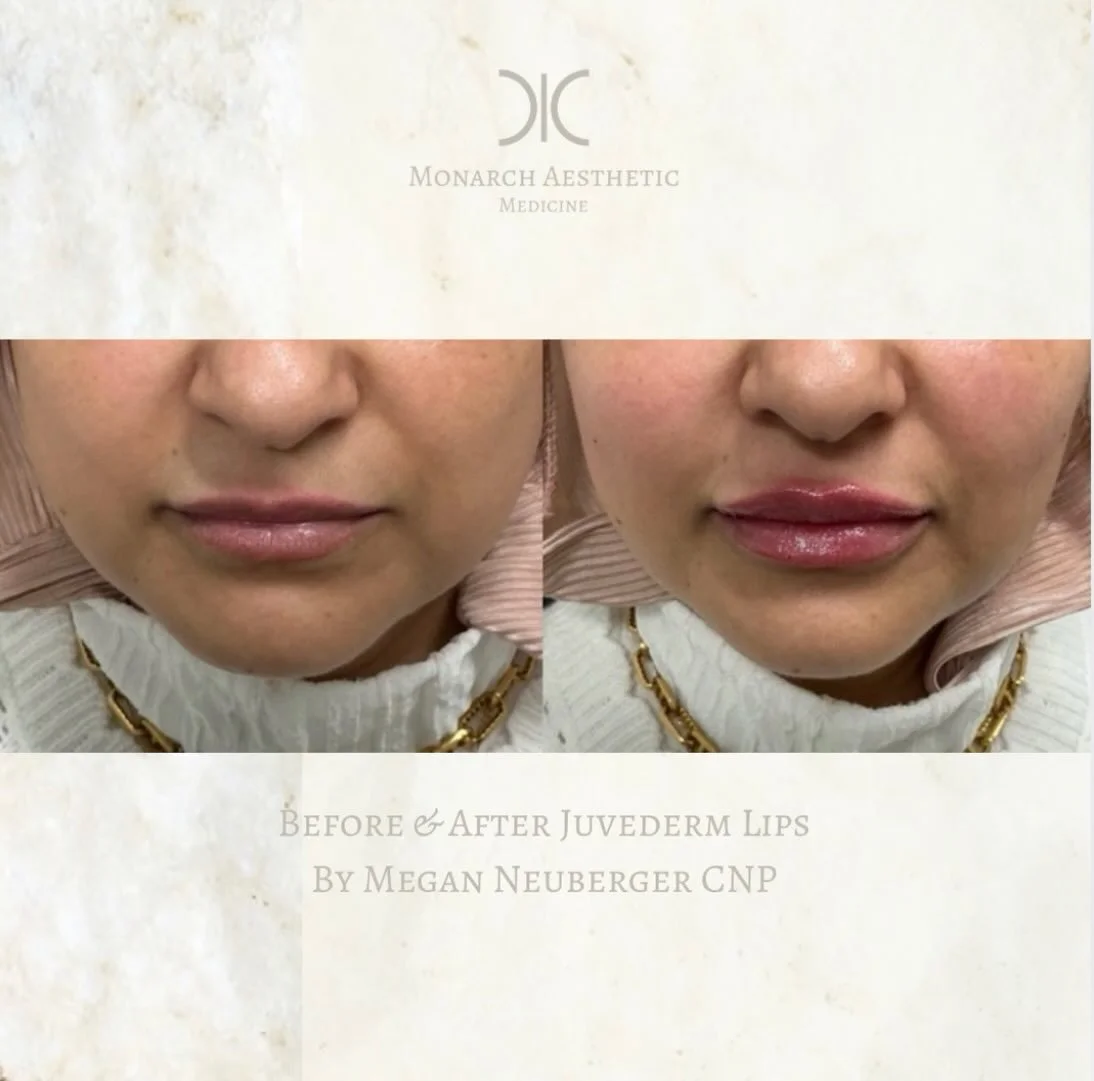 #beautiful #juvedermlips by Megan! Don&rsquo;t forget you can still get #free #lipfiller and #skinvive with the purchase of 2 JUVEDERM cheek fillers this month! Don&rsquo;t miss out! Book now! 
☎️6145452002
💻www.monarch-aesthetic.com