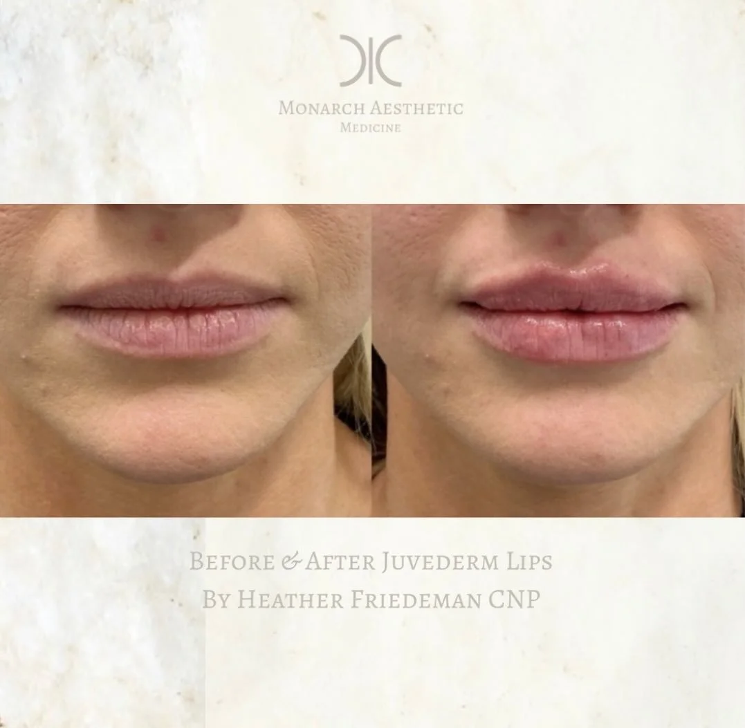 #stunning #juvedermlips on this gorgeous patient! #beforeandafterlips #columbusmedspa last few days to get FREE lip filler and skinvive when you buy 2 JUVEDERM voluma cheek fillers! 
☎️6145452002
💻www.monarch-aesthetic.com