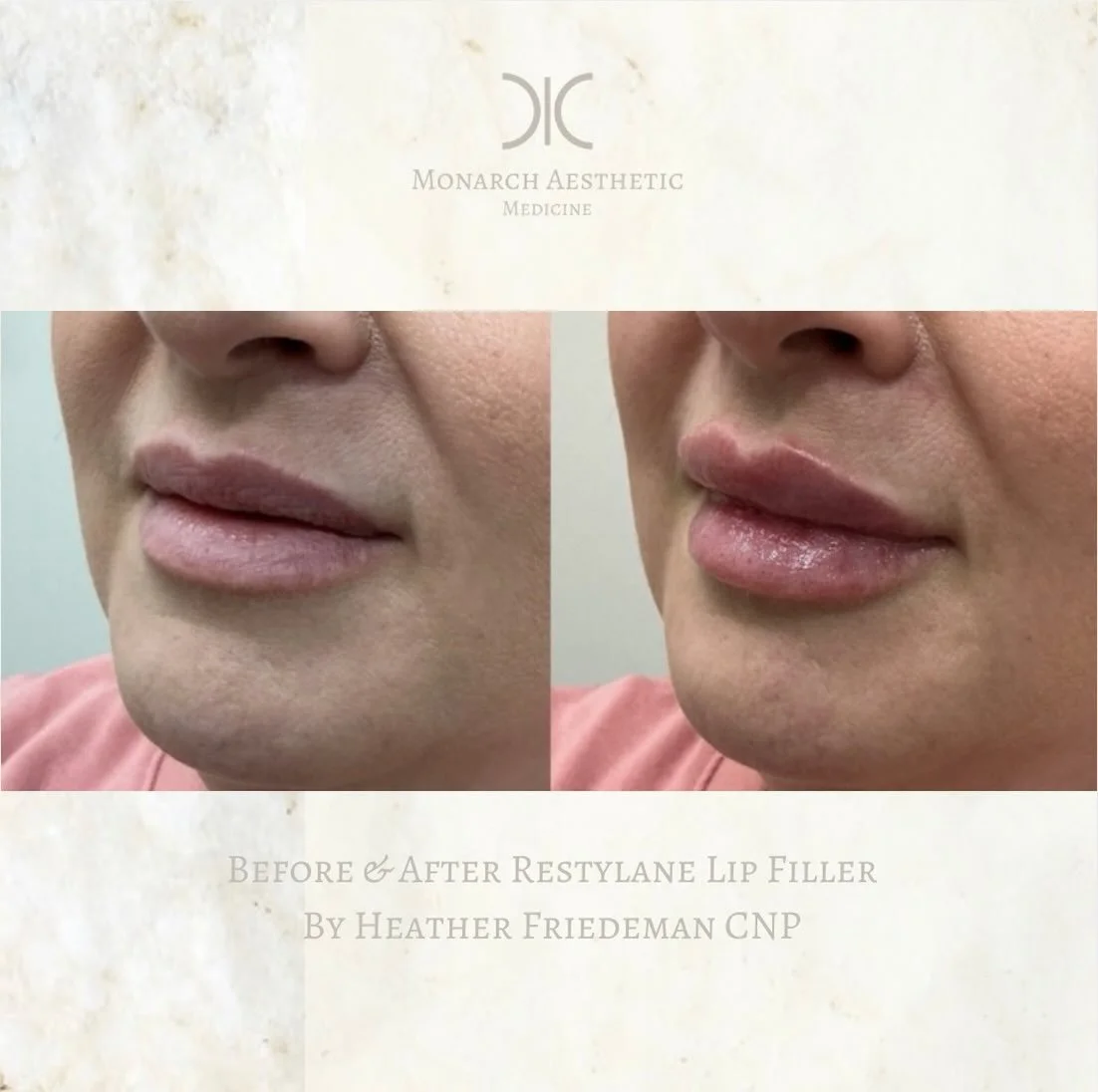 Bringing you consistently gorgeous #results ! #beforeandafter #lipfiller #columbusmedspa #expertinjector booknow for $499 restylane Kysse or JUVEDERM ultra plus lips in May while supplies last! 
☎️6145452002
💻www.monarch-aesthetic.com