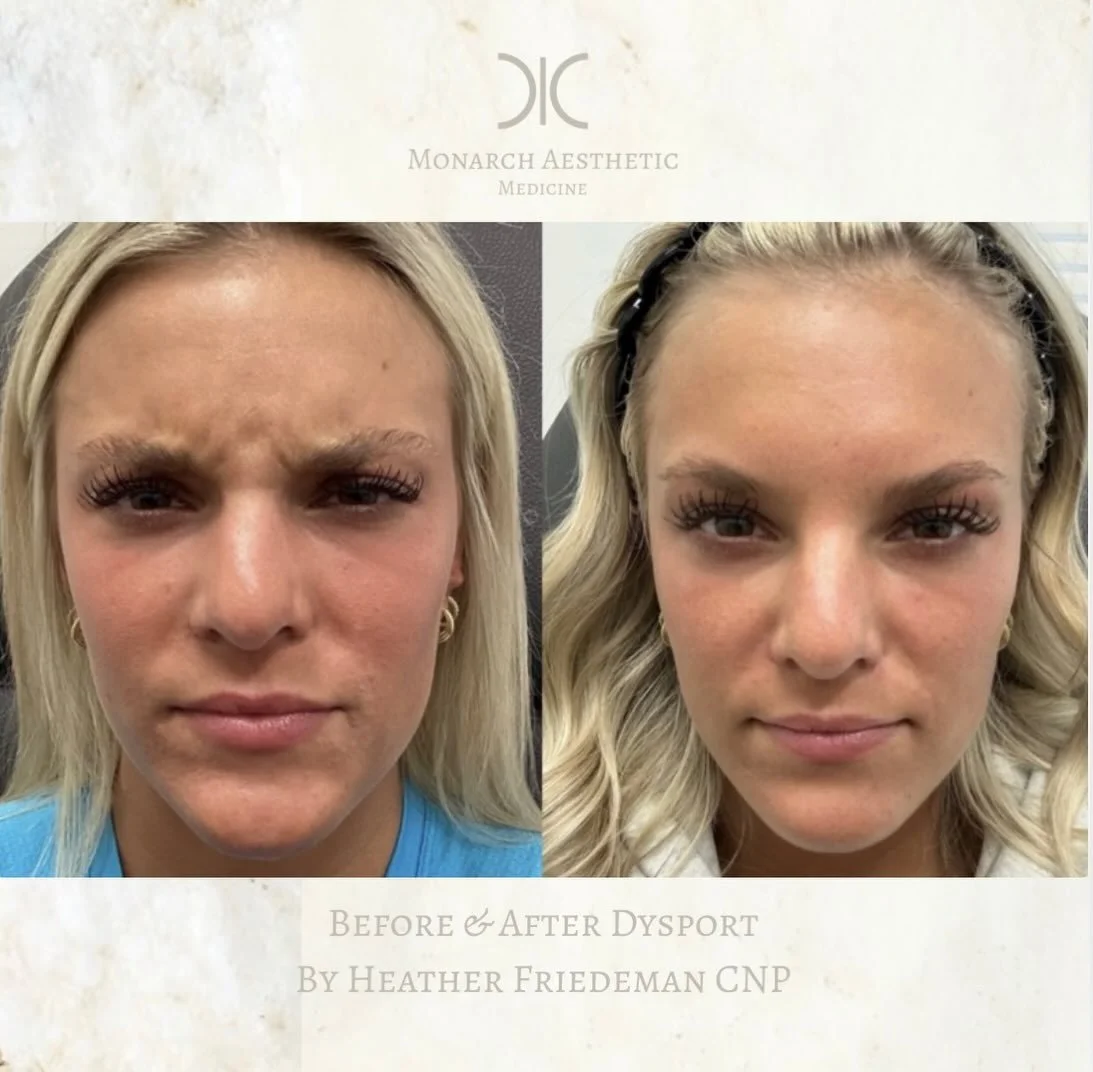 Love a full face #dysport&reg; refresh! #beforeandafter #toxresults #columbusmedspa #asseenincbus 
☎️6145452002
💻www.monarch-aesthetic.com