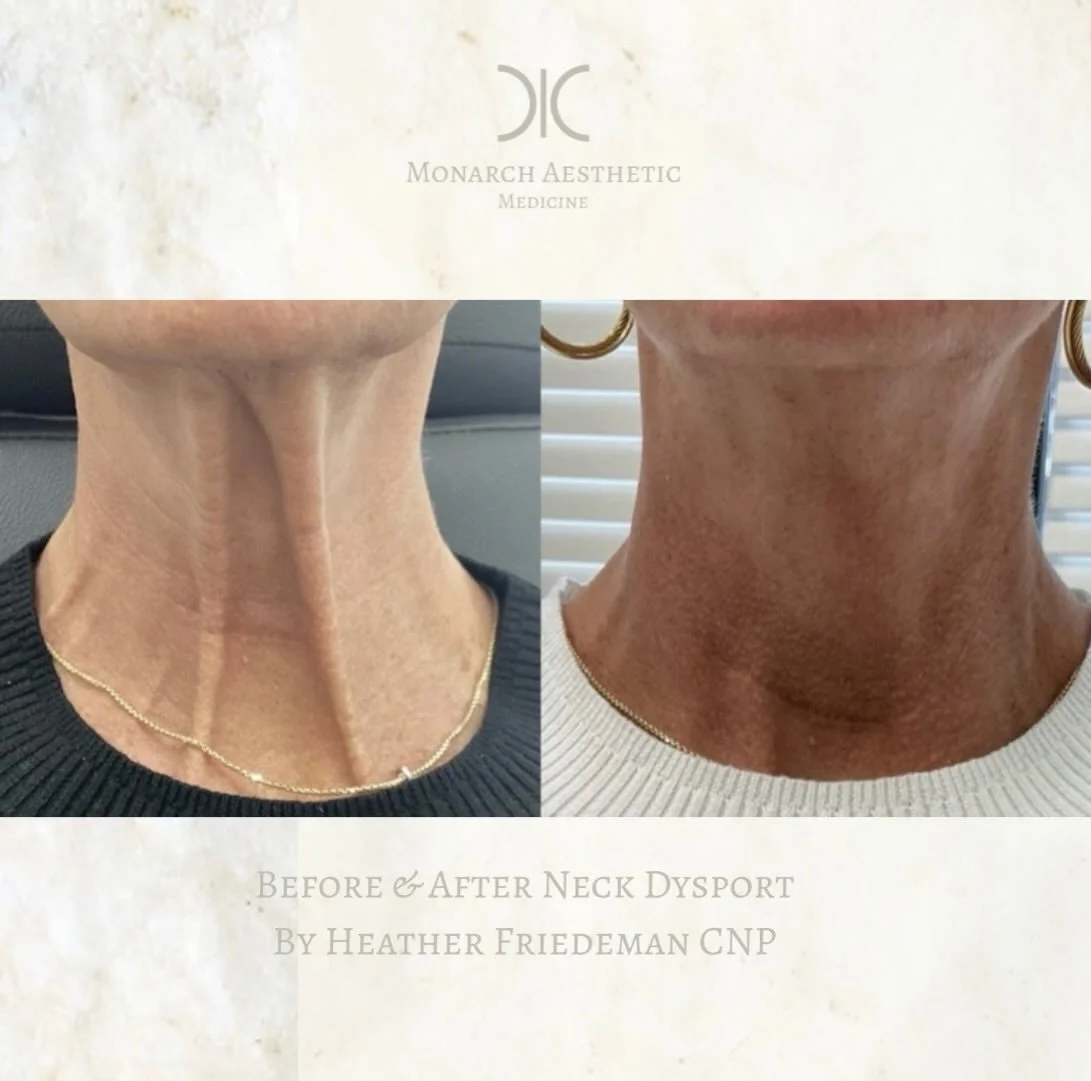 It&rsquo;s not magic it&rsquo;s just a little #dysport&reg; in the platysmal bands! #beforeandafter #columbusmedspa #expertinjector #botox 
☎️6145452002
💻www.monarch-aesthetic.com