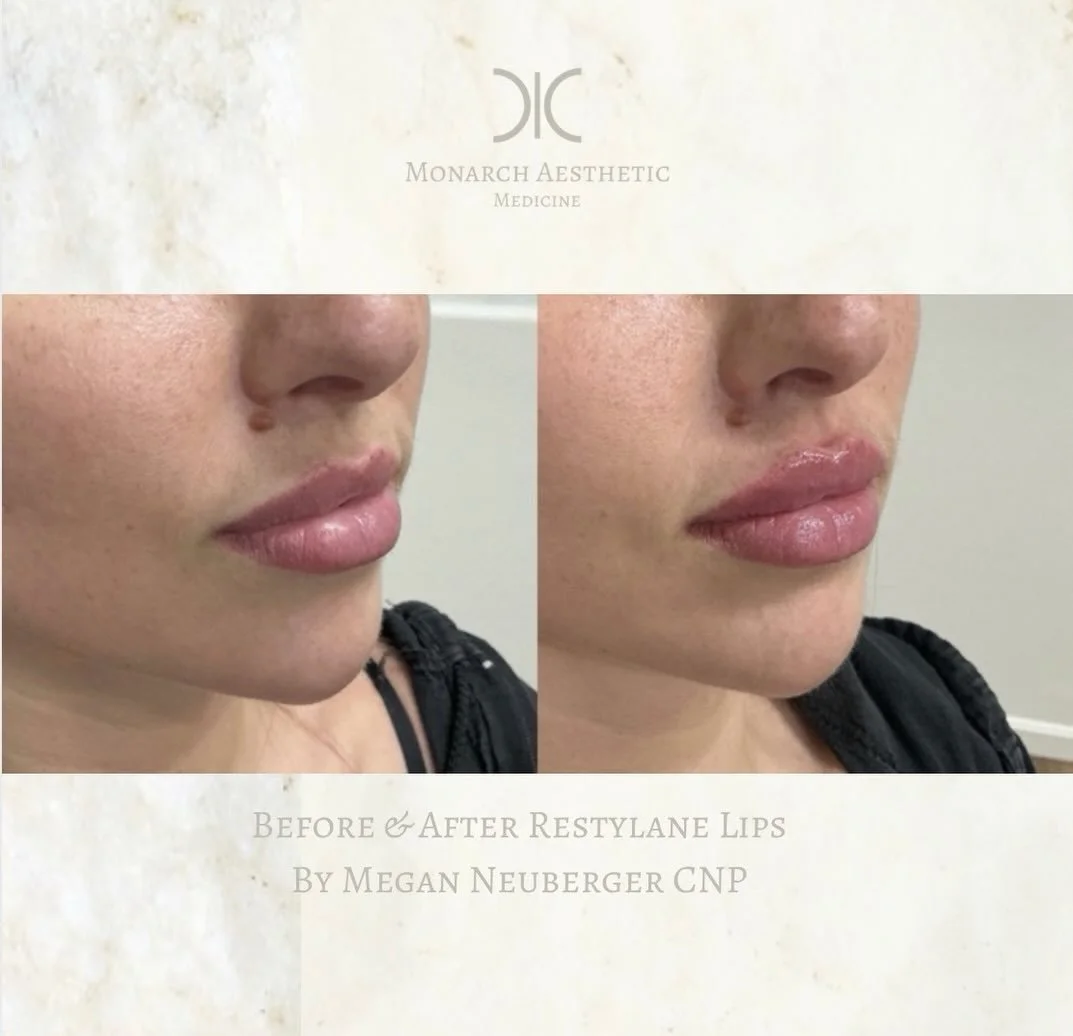#stunninglips #beforeandafter #columbusmedspa #expertinjector #lipfillerbeforeandafter