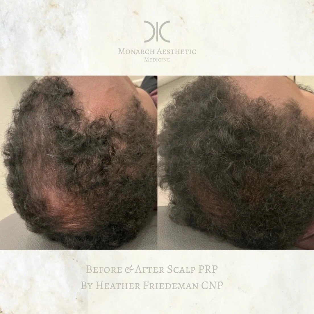 Amazing #results from 3 sessions of #scalpprp #hairrestoration and #sunetics #columbusmedspa 
☎️6145452002
💻www.monarch-aesthetic.com