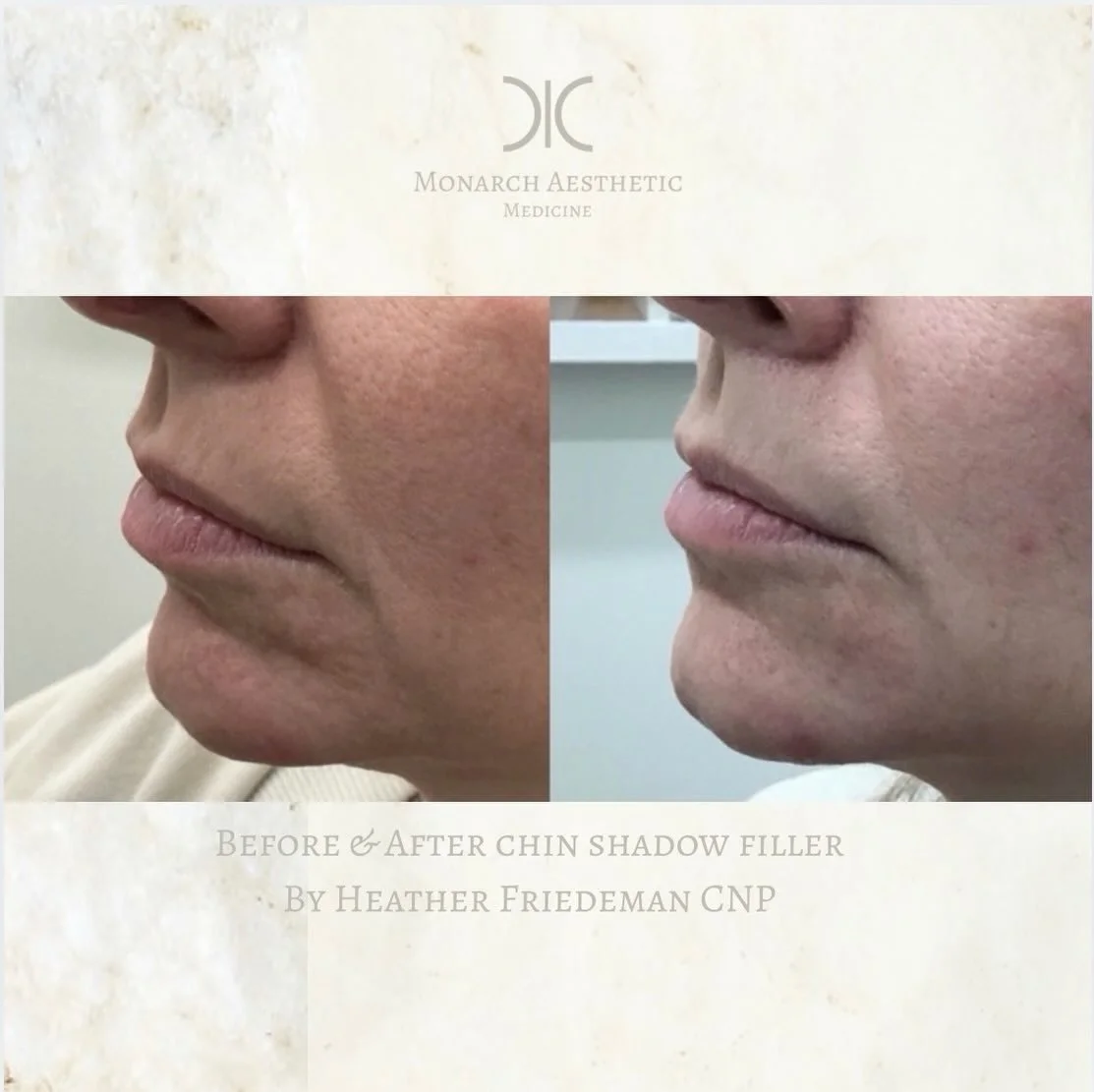 #filler in the #chinshadow gives support and structure to the lower face while Improving the profile, jawline, and reducing appearance or jowls! Amazing #results from just 1 syringe! #columbusmedspa #beforeandafter 
☎️6145452002
💻www.monarch-aesthet
