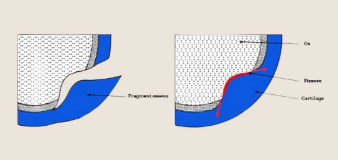 Ostéochondrose / ostéochondrite disséquante