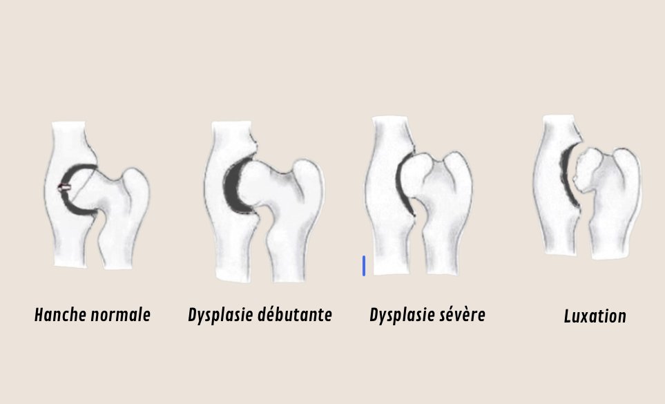 dysplasie hanche