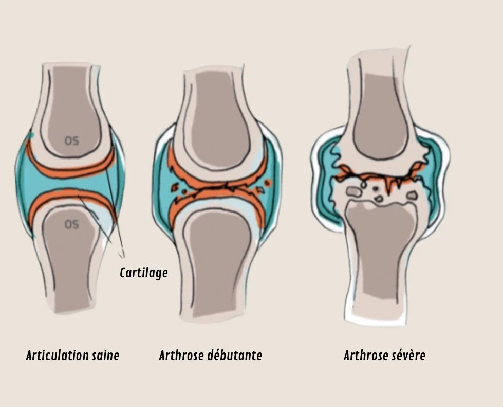 arthrose