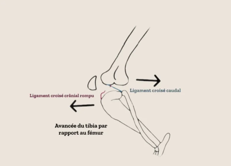Rupture ligaments croisés