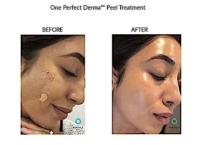 Comparison of a woman's face before and after using One Perfect Derma peel treatment, showing clearer skin in the after image.