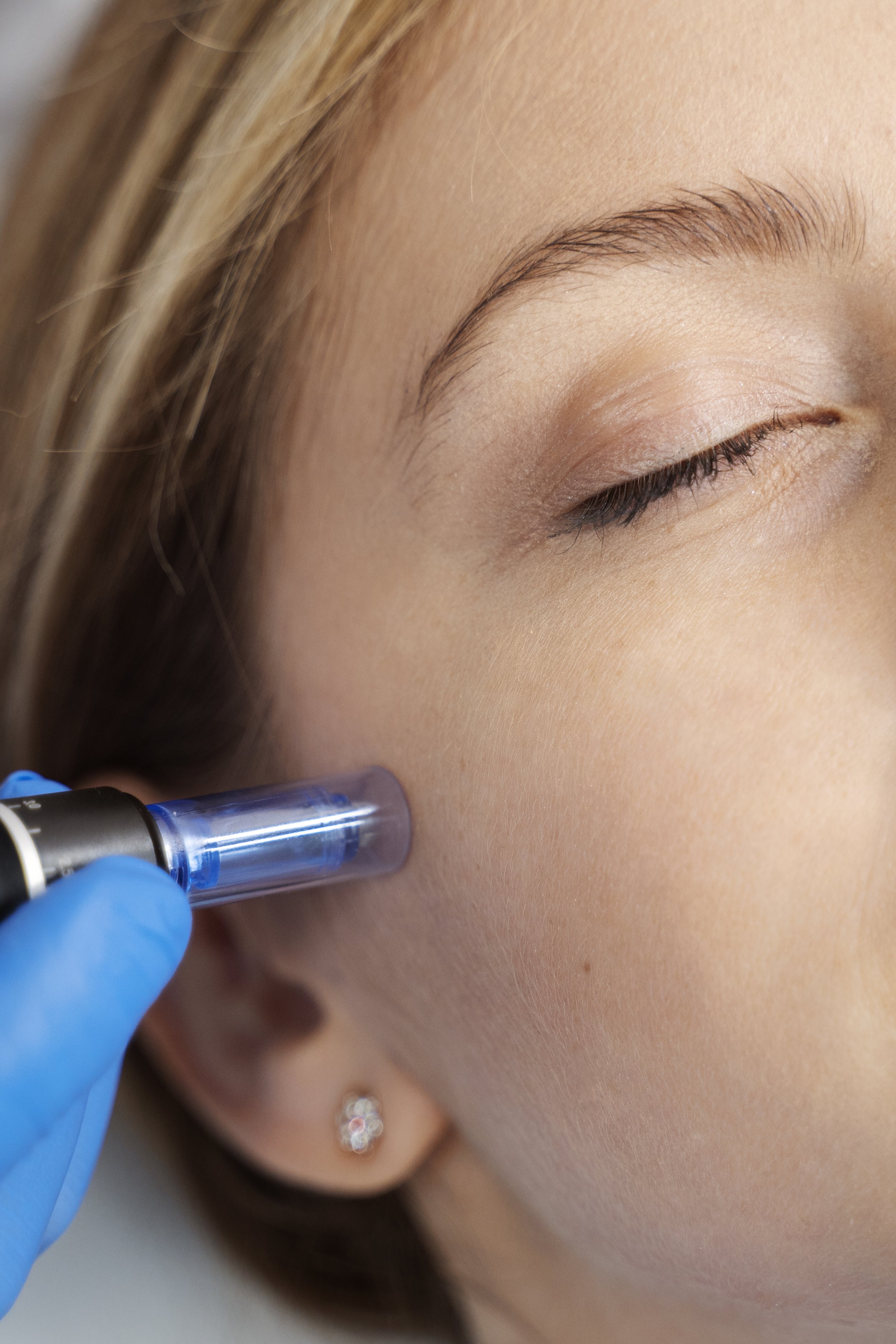 RF-Microneedling