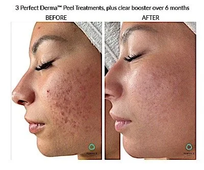 Side-by-side comparison of a woman's facial skin before and after 6 months of using Peel Treatments, showing clearer, smoother skin in the after image.