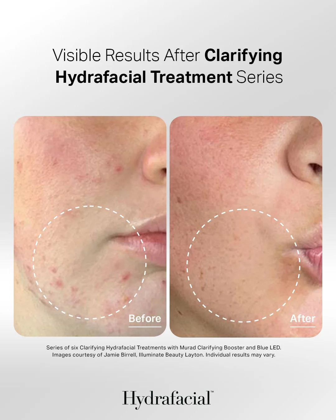 Side-by-side comparison of a person's face before and after hydrafacial treatment, showing improvement in skin clarity and reduction of blemishes.