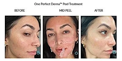 Comparison of skin before, during, and after a peel treatment showing improved appearance of skin.